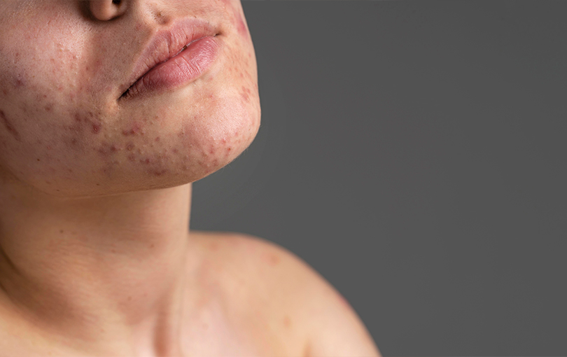 causas da acne - Causas da acne e os melhores tratamentos: aprenda a sanar esse problema que afeta a sua pele