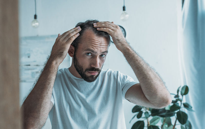 condicao pode ser amenizada - Entenda mais sobre a alopecia e como essa condição pode ser amenizada