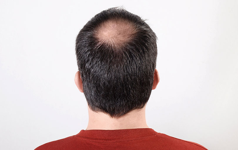 Entenda mais sobre a alopecia e como essa condição pode ser amenizada