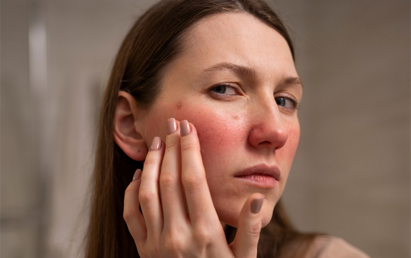 como fazer uma rotina de cuidados da pele com rosacea - Saiba como fazer uma rotina de cuidados para a pele com rosácea